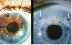 An iridotomy is an opening created in the iris, usually by a laser