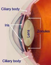 Iritis is inflammation predominantly located in the iris of the eye